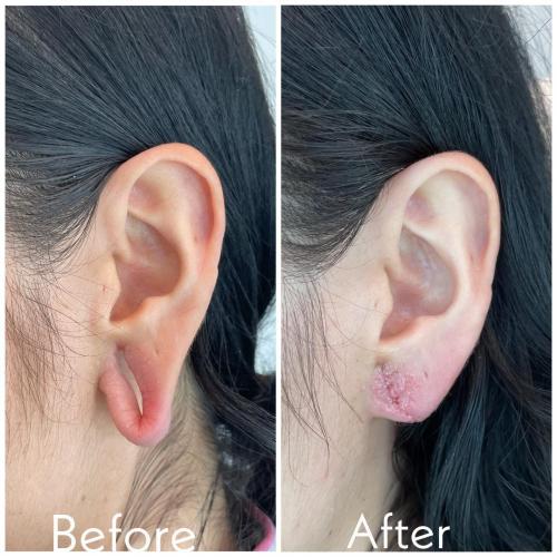 ear-lobe-repair